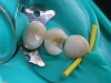 Реставрации боковых зубов